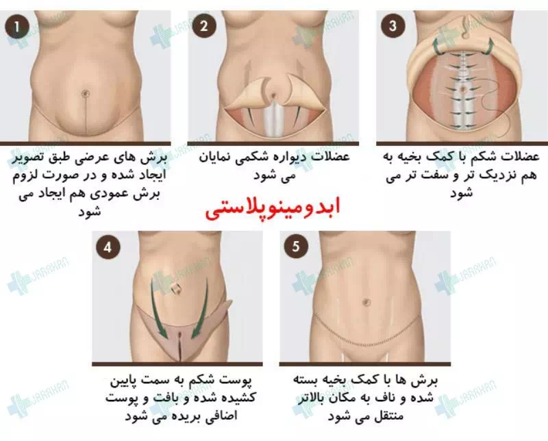 مراحل جراحی زیبایی شکم یا عمل ابدومینوپلاستی